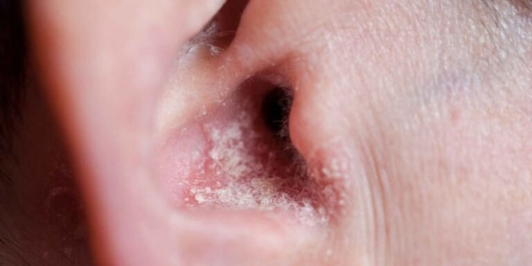 Eczema or Psoriasis of the Ear Canal: Causes, Symptoms & Treatment