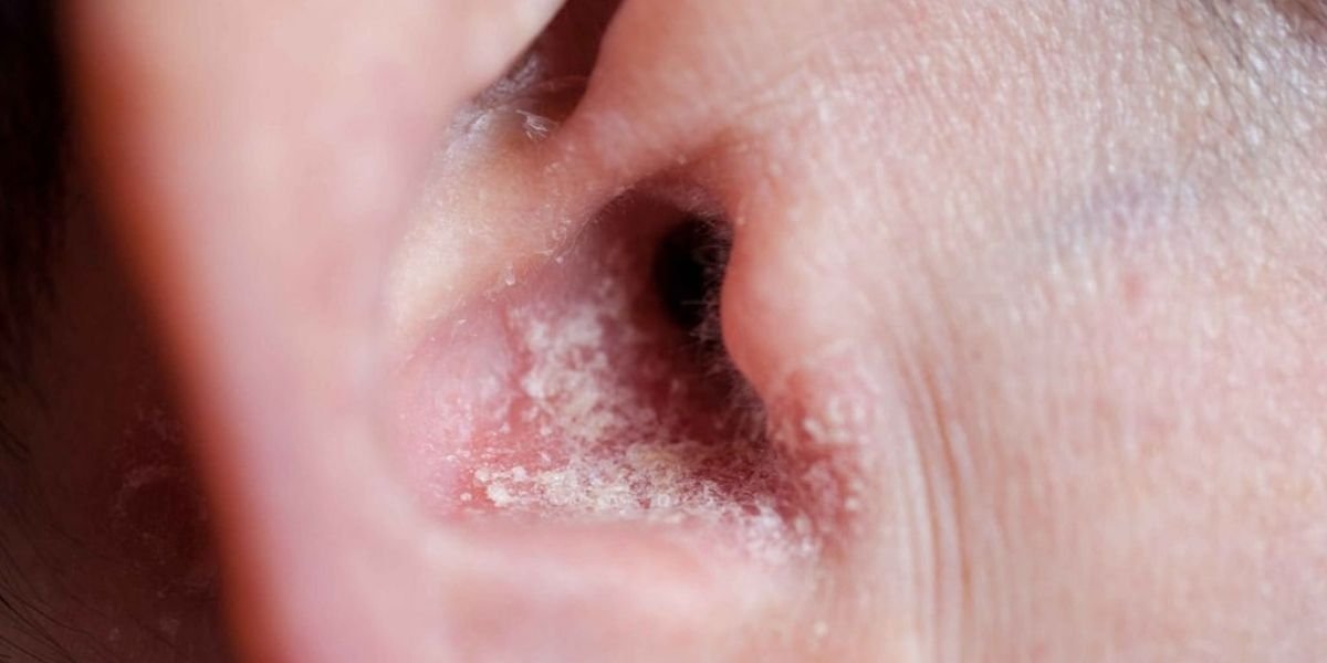 Eczema or Psoriasis of the Ear Canal: Causes, Symptoms & Treatment