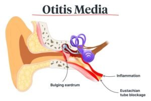 (Otitis Media with Effusion): All You Need to Know